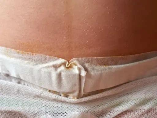 Närbild på ett ärr efter kejsarsnitt med ett vitt förband. Det kan vara tecken på komplikationer efter kejsarsnitt.