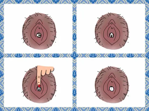 Illustration visar hur en menskopp vecklar ut sig. En hand trycker på den för att hjälpa den att veckla ut sig.