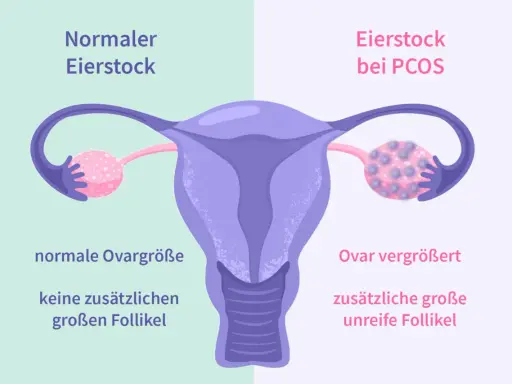 Porównanie jajnika: normalny jajnik z małą ilością pęcherzyków i jajnik przy PCOS z licznymi, niedojrzałymi pęcherzykami, co jest jednym z objawów PCOS.