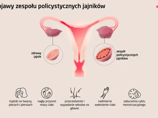 PCOS: Co to jest? Objawy, leczenie i życie z Zespołem Policystycznych Jajników