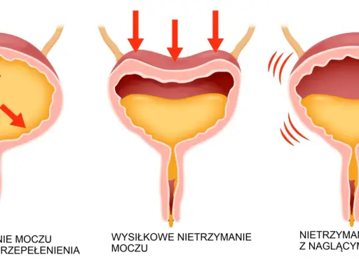 Ilustracja przedstawia trzy rodzaje nietrzymania moczu: przepełnienie, wysiłkowe i z nagłymi parciami.