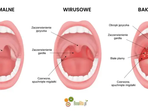 Ilustracja porównująca zdrowe gardło z gardłem w anginie wirusowej i bakteryjnej.