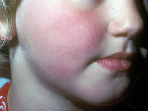 Barnets kinder är röda, vilket kan vara ett tecken på hjärnhinneinflammation. Utslagen är diffusa och rodnande.