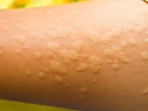 Pelle di bambino con pomfi rossastri e gonfi, tipici dell'orticaria.