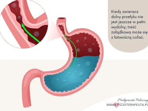 Ilustracja pokazuje żołądek i przełyk, wyjaśniając mechanizm ukrytego refluksu u niemowlaka, gdy treść żołądkowa cofa się do przełyku.