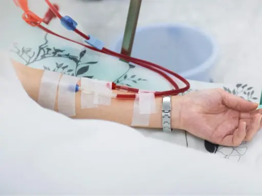 Ramię pacjenta z założonym cewnikiem Sheldona, podłączonym do aparatury dializacyjnej.