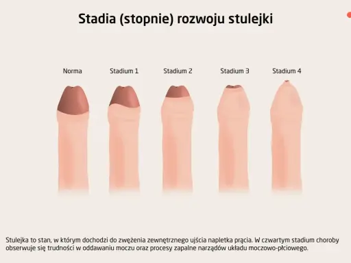 Ilustracja pokazuje, jak wygląda penis w różnych stadiach stulejki, od normy do stadium 4.