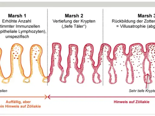 Darstellung der Marsh-Klassifikation von Zöliakie: Von gesunder Schleimhaut (Marsh 0) über Entzündung (Marsh 1-2) bis zur Zottenatrophie (Marsh 3), die bei einer **Haferallergie** auftreten kann.