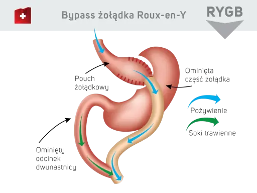 Schemat bajpas żołądka Roux-en-Y. Pokazuje, jak pokarm i soki trawienne omijają część żołądka i dwunastnicy.