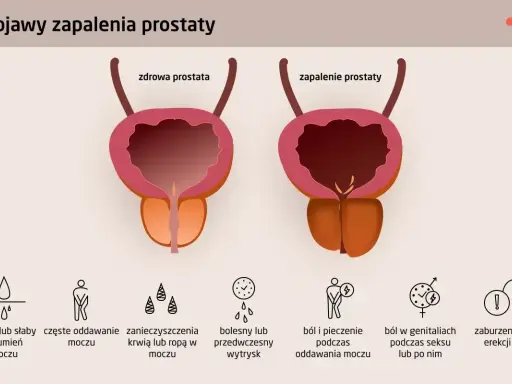 Zapalenie prostaty może powodować objawy takie jak cienki lub słaby strumień moczu, ból, pieczenie, a nawet zaburzenia erekcji.