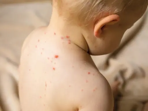 Enfant atteint de varicelle, avec des boutons rouges sur le dos et le cou. Conseils pour aider à comment faire sécher les boutons de varicelle rapidement.