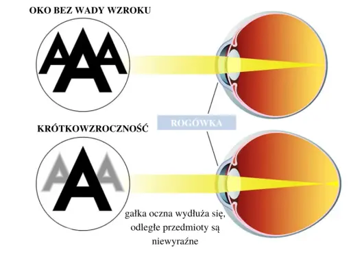Oko z krótkowzrocznością widzi litery "AAA" niewyraźnie, bo gałka oczna jest za długa. Oko bez wady widzi ostro.
