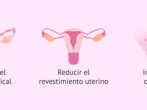 Ilustración de métodos anticonceptivos: espesa el moco cervical, reduce el revestimiento uterino e impide la ovulación. El diu en España es una opción.