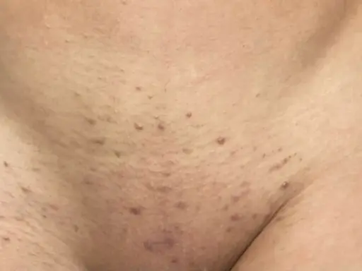 Peau présentant des boutons après rasage, avec des rougeurs et de petites imperfections.