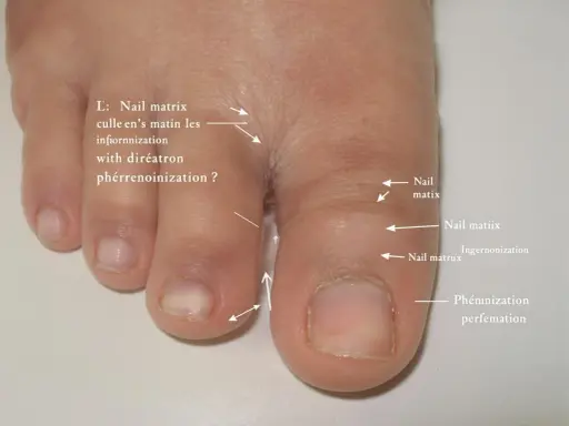 Gros orteil avec ongle incarné. Le prix d'une consultation podologue pour ce problème est indiqué.