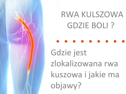 Rwa kulszowa objawy gdzie boli? Grafika pokazuje przebieg nerwu kulszowego, który jest źródłem bólu.