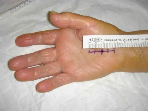 Main de patiente avec marques violettes et règle millimétrée, indiquant la zone d'intervention pour un syndrome du canal carpien.