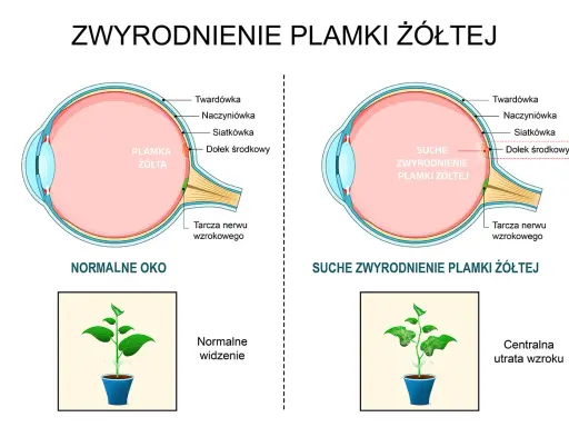 Porównanie zdrowego oka z plamką żółtą i oka z suchym zwyrodnieniem plamki żółtej, pokazujące utratę ostrości widzenia.