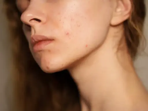 Visage d'une jeune femme avec des rougeurs et des marques de cicatrice acné sur la joue et le menton.