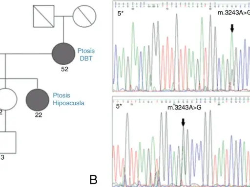 Pedigrí que muestra herencia mitocondrial de ptosis y hipoacusia, junto a electroforesis que confirma la mutación m.3243A>G.