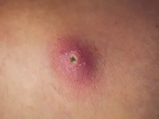 Gros plan d'un furoncle sur la cuisse, rouge et enflammé, avec un centre sombre.