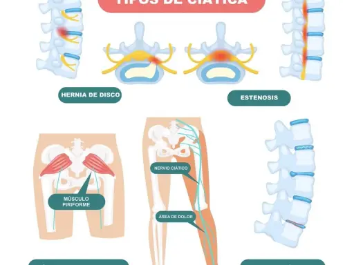 ¿Es ciática? Reconoce síntomas, causas y cuándo actuar