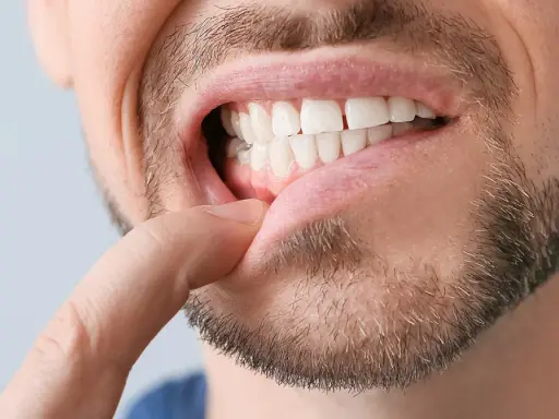 Ropa na dziąśle: Jak bezpiecznie usunąć i kiedy do dentysty?