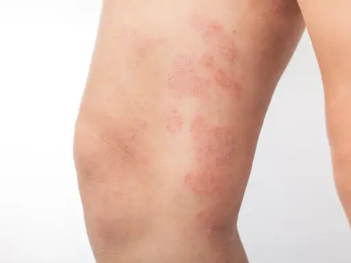 Plaques rouges et squameuses sur la cuisse, indiquant un **eczéma cuisse**. La peau semble irritée et sèche.