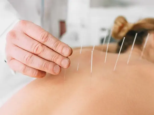 Dłoń terapeuty aplikuje igły do akupunktury na plecach pacjentki. To pokazuje, czym jest akupunktura.