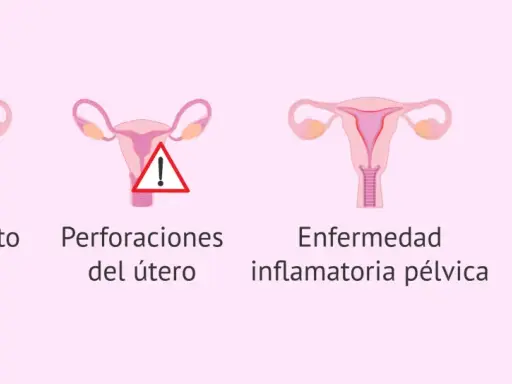 Ilustración de útero con DIU, deslizamiento, perforación, enfermedad inflamatoria pélvica e infección uterina. Reposo tras colocar el DIU Mirena.