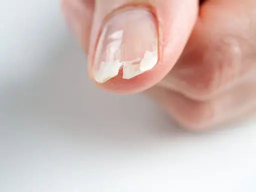 Unghie che si deformano, con strati che si sfaldano e si spezzano, mostrando fragilità.