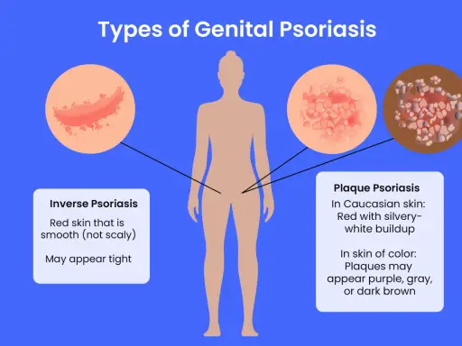 Illustration des types de psoriasis génital, y compris le psoriasis inversé et le psoriasis en plaques, qui peuvent affecter le pénis.