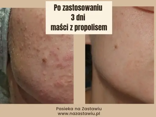 Przed i po 3 dniach stosowania maści z propolisem. Skóra z niedoskonałościami staje się gładsza.