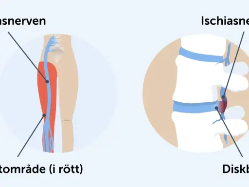 Illustration av ischiasnerven och smärtområde i benet, samt diskbråck som orsakar falsk ischias.