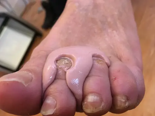Orthoplastie podologue : un pansement rose est appliqué entre les orteils pour soulager une douleur.