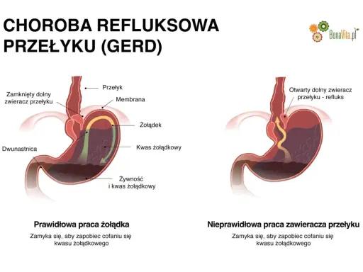 Ilustracja pokazuje refluks żołądkowo-przełykowy, który może powodować ból gardła. Po lewej prawidłowe działanie żołądka, po prawej refluks.