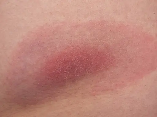 Rumień wędrujący, objaw kleszcza pod skórą, rozszerza się. Czerwona plama na skórze.