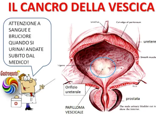 Illustrazione anatomica della vescica maschile con un'area evidenziata che indica un tumore alla vescica. Avviso: sangue e bruciore durante la minzione richiedono visita medica immediata.