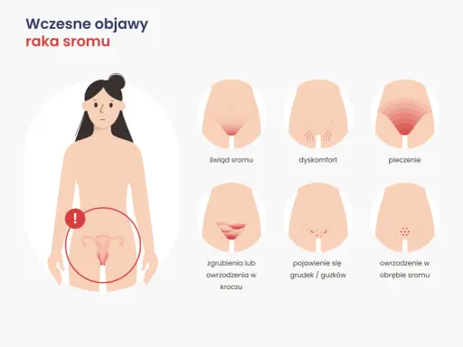 Ilustracja pokazuje wczesne objawy raka sromu: świąd, pieczenie, dyskomfort, zgrubienia, grudki i owrzodzenia.