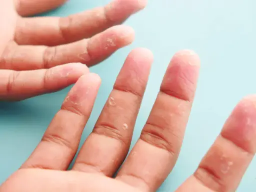 Mains affectées par la dyshidrose, avec des vésicules et une peau qui pèle sur les doigts.