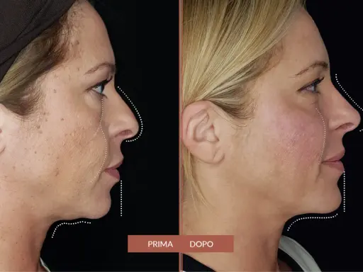 Prima e dopo: il filler full face ha ridefinito i contorni del viso, migliorando la pienezza e la definizione.