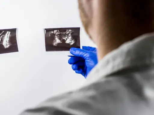 Lekarz w niebieskich rękawiczkach analizuje dwa zdjęcia USG, szukając odpowiedzi na pytanie: rak prostaty ile się żyje.