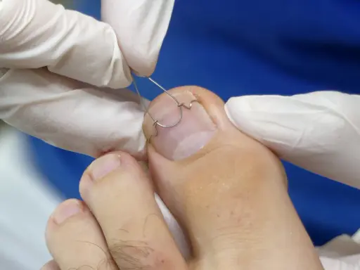 Application d'une orthonyxie sur un ongle incarné. Des mains gantées ajustent un fil métallique pour corriger la courbure de l'ongle.