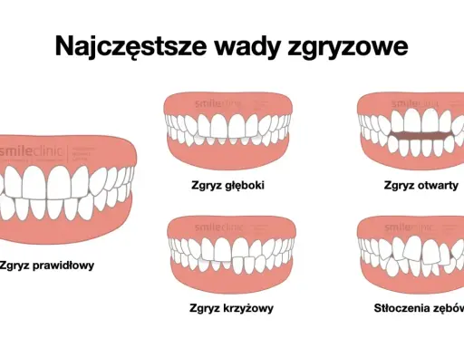 Ilustracje pokazują różne wady zgryzu: prawidłowy, głęboki, otwarty, krzyżowy i stłoczenia zębów.