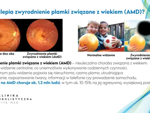 Badanie dna oka co wykrywa: zdrowe oko vs. zwyrodnienie plamki związane z wiekiem (AMD), wpływające na widzenie.