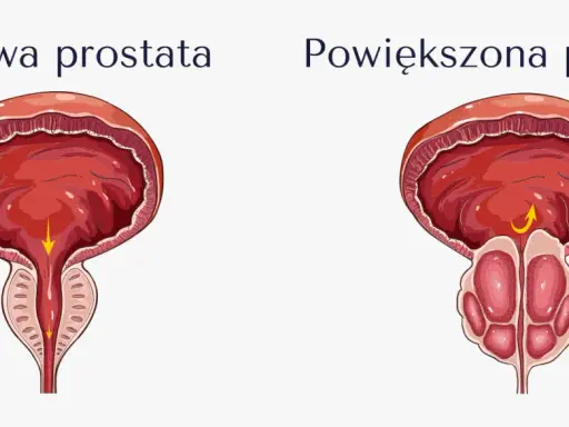 Porównanie zdrowej i powiększonej prostaty. Powiększona prostata może powodować problemy z oddawaniem moczu, co jest jednym z objawów przerostu gruczołu krokowego.