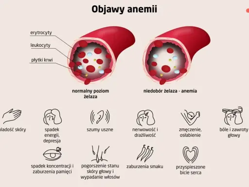 Objawy anemii: bladość, zmęczenie, bóle głowy. Leczenie anemii jest kluczowe dla poprawy samopoczucia.