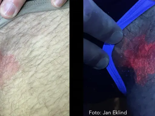 Hudförändring som kan vara leishmania hos människa. Till vänster syns en röd, fjällande fläck. Till höger, under UV-ljus, lyser fläcken starkt rött.