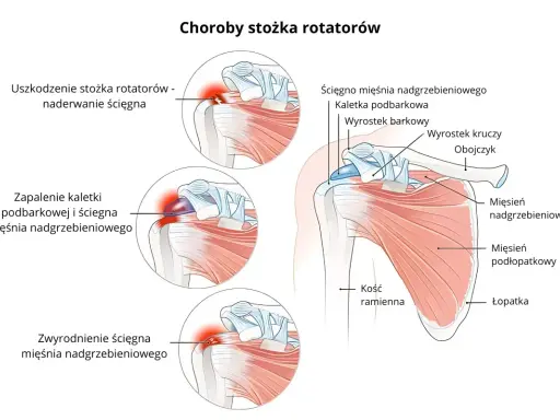 Ilustracja przedstawia budowę stawu barkowego i schorzenia mięśnia nadgrzebieniowego: naderwanie, zapalenie kaletki i zwyrodnienie ścięgna.