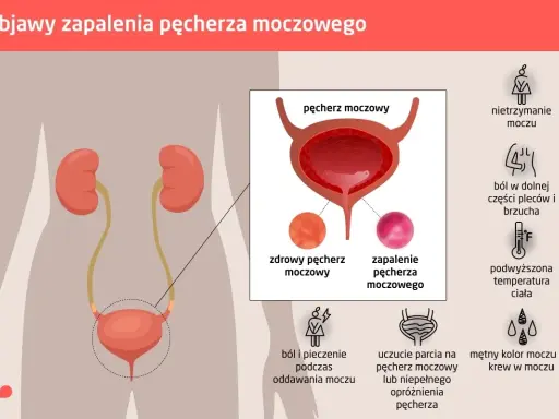 Objawy zapalenia pęcherza: ból, pieczenie, nietrzymanie moczu, gorączka, ból pleców, uczucie parcia, mętny mocz lub krew w moczu.